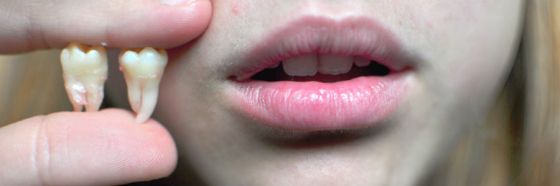 El diente roto, Pedro Emilio Coll